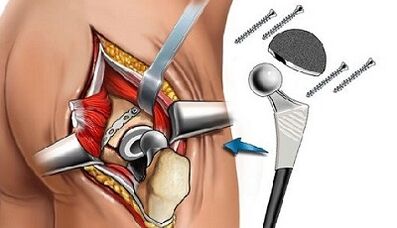 Endoprothetic for hip arthrosis