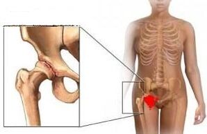 The reasons for the development of arthrosis of the hip joint
