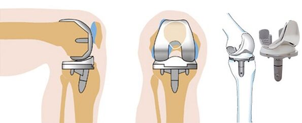 Endoprothetic operation of the knee joint for arthrosis