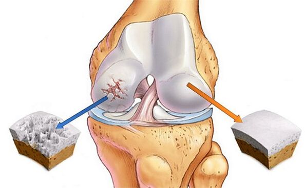 Norm and deviation for the arthrosis of the knee joint
