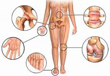 Arthritis and arthrosis of various joints