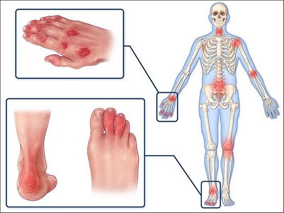 Redness of the skin and swelling of the joints with arthritis