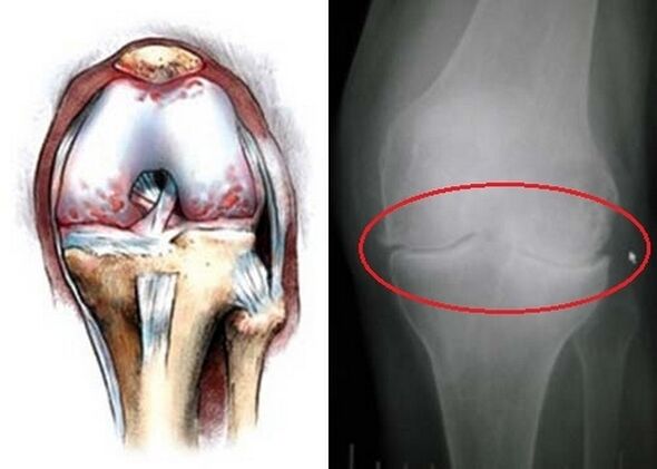 The deformation of the knee joint for arthrosis