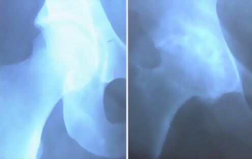 image of arthrosis of the knee joint