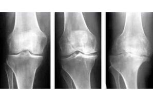 stages of arthrosis of the joint on an x-ray